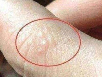 夏天脚上起小水泡很痒是怎么回事,每到夏天手上就起小水泡怎么回事