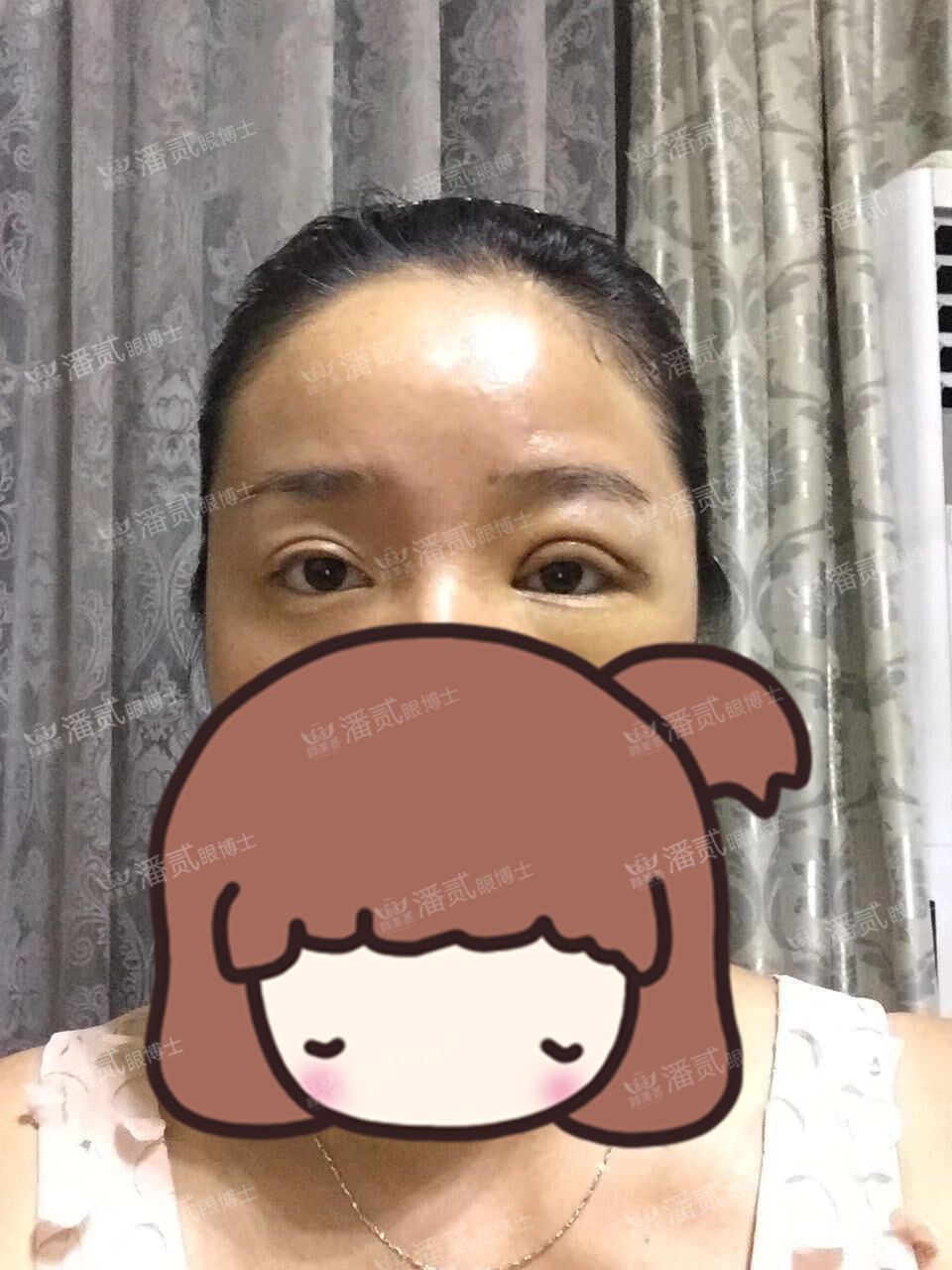 提肌矫正失败的表现眼皮睁不开,做完提肌眼睛前半段下垂