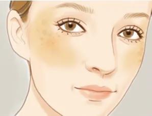 如何区别脸上斑是雀斑还是黄褐斑,雀斑和褐斑有什么区别吗