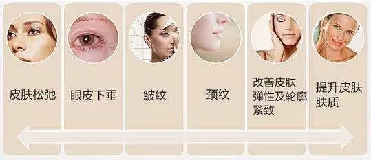 超声刀会使脸变得特饱满,超声刀能抚平皱纹吗