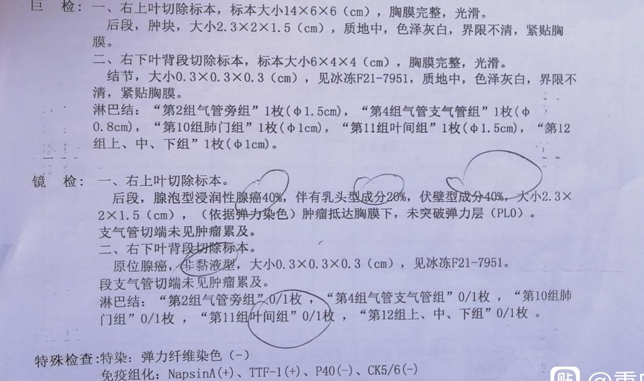 肺癌知识点护考,肺癌知识讲座总结