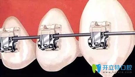 德国飞凡自锁托槽和国产区别,自锁金属牙套品牌有区别吗