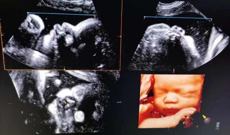 孕期超声检查，虽然“有点烦”，但不可不做哟~