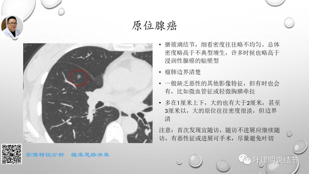 叶建明谈肺实性小结节视频,廖正银教授谈肺结节
