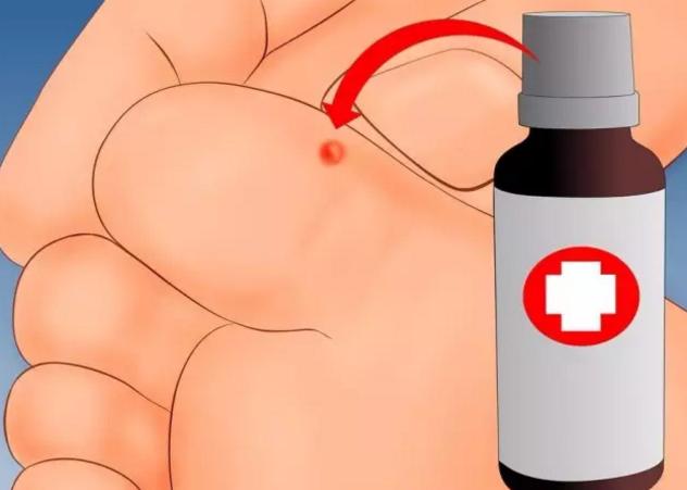 瘊子会自己消失不用治？NO！你的瘊子会传染全家人！