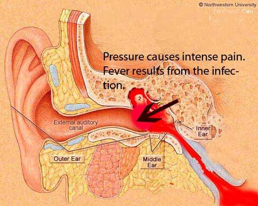 引发中耳炎的原因是什么,引起中耳炎的原因