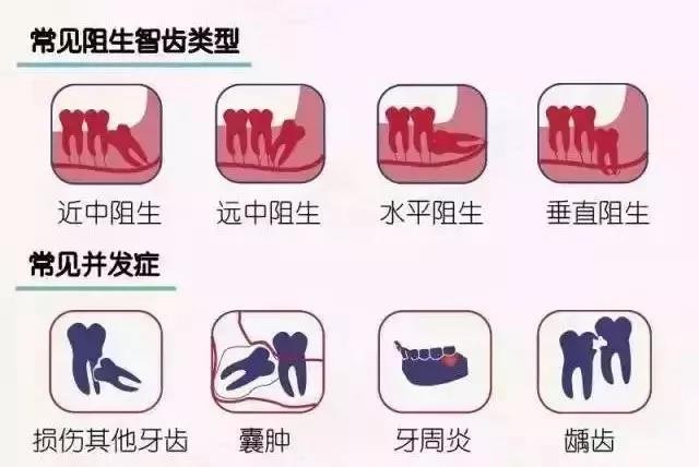 智齿到底应不应该拔,智齿到底要不要拔除