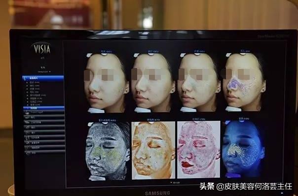 visia皮肤检测仪,visia皮肤检测报告数值越大越好吗
