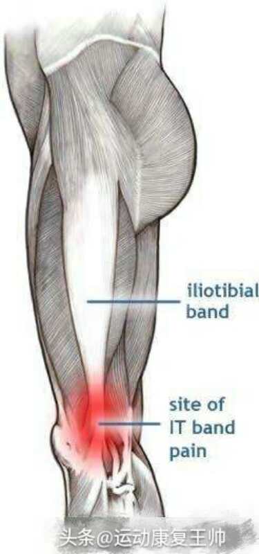 如何训练解决跑步后膝盖痛,跑步膝如何判断是否康复