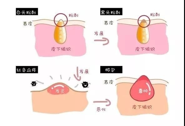 满脸都是闭口,满脸都是闭口的状态