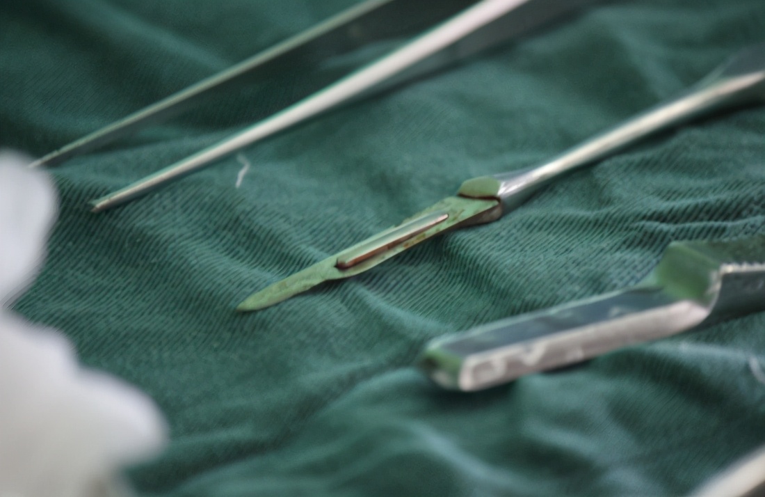 结石做微创手术全过程,十年前的结石终于手术了