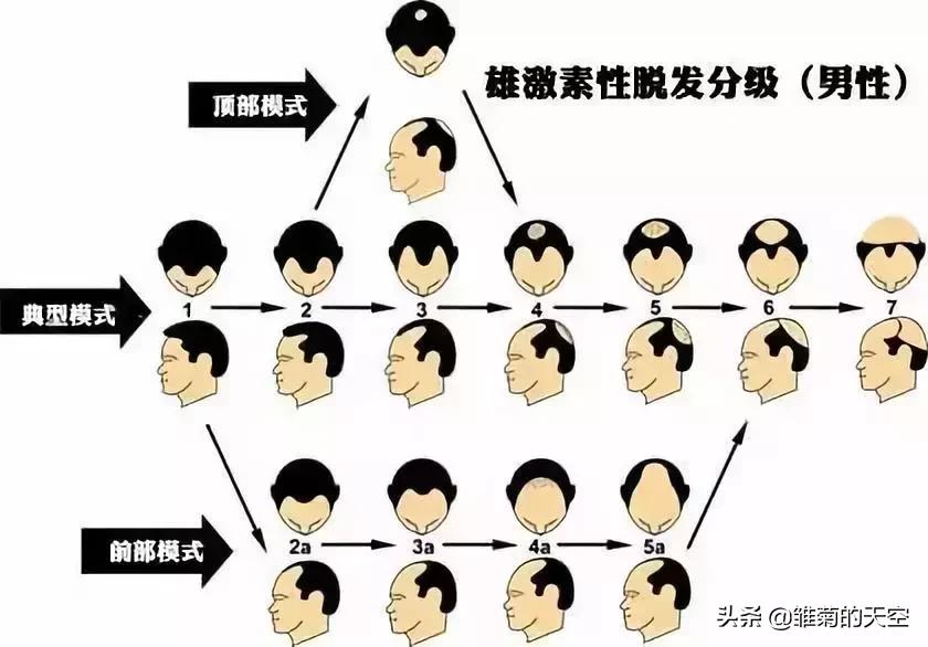 20岁脱发和45岁脱发的区别,听说90后第一批已经开始脱发了