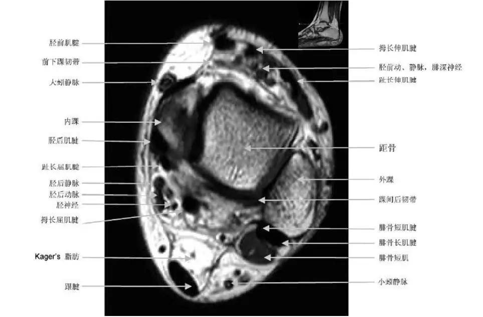 踝关节撞击症问诊,踝关节撞击综合征的x线表现