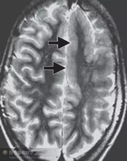 儿童癫痫CT表现,儿童各类癫痫脑电图特征