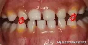 牙齿矫正地包天多久能看到效果,地包天越早矫正越好吗