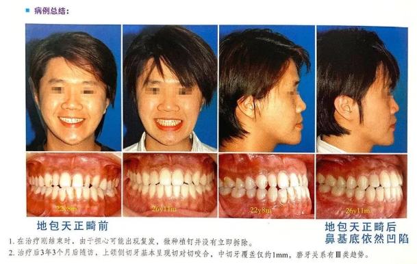 法令纹鼻基底填充玻尿酸方法,鼻基底底法令纹深怎么整