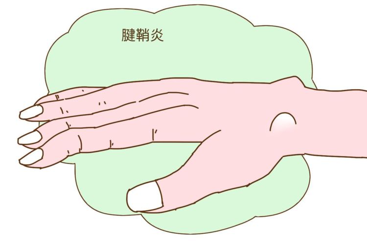 大拇指不敢动,大拇指腱鞘炎不疼有轻微的弹响