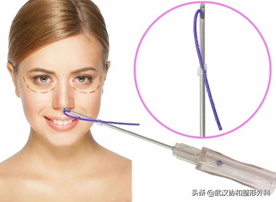 为什么不建议做线雕隆鼻手术,为什么不建议做线雕隆鼻