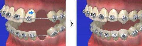 七类牙医,为什么医生不建议拔7号牙齿