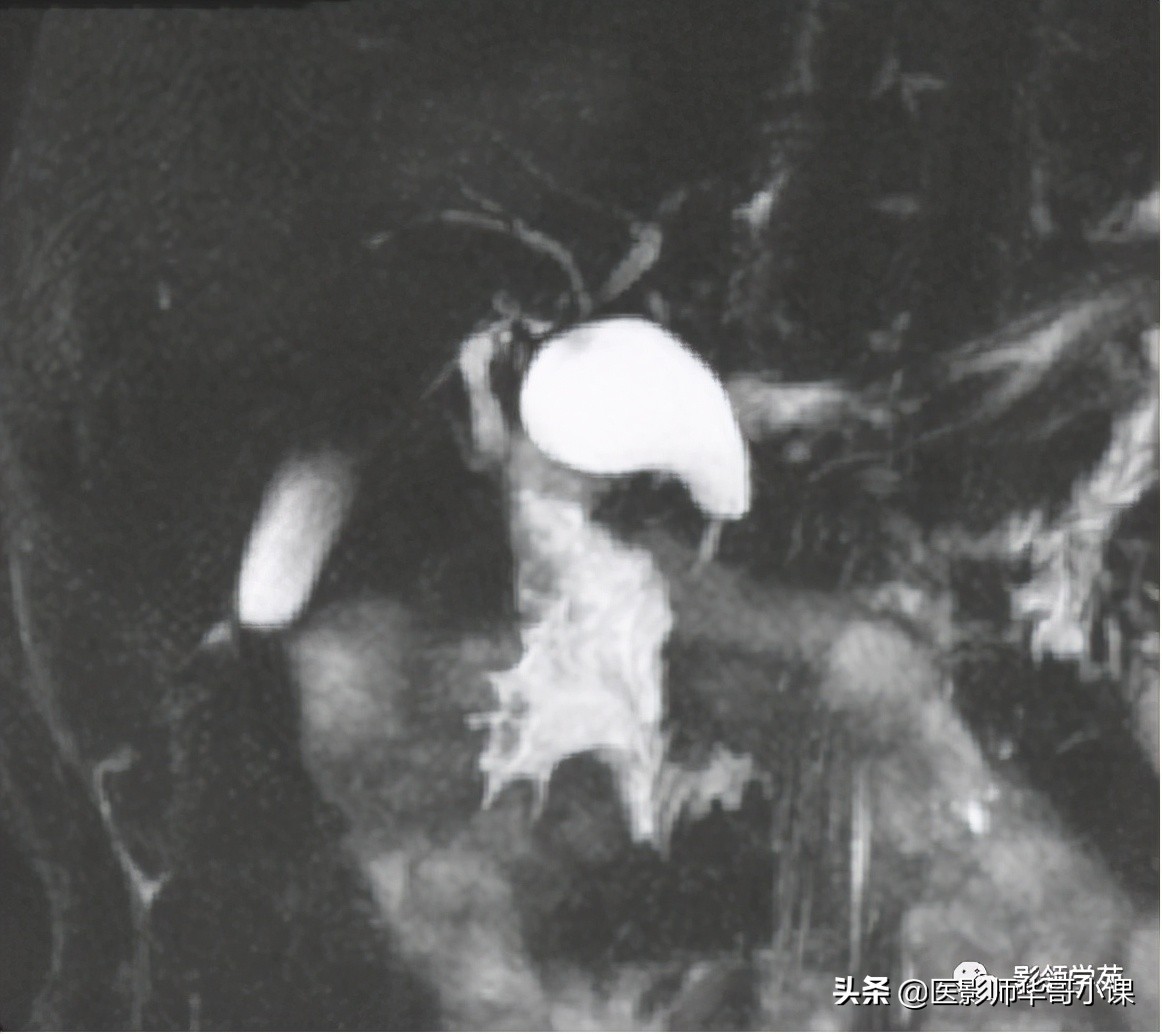 胆总管变异,胆胰管解剖