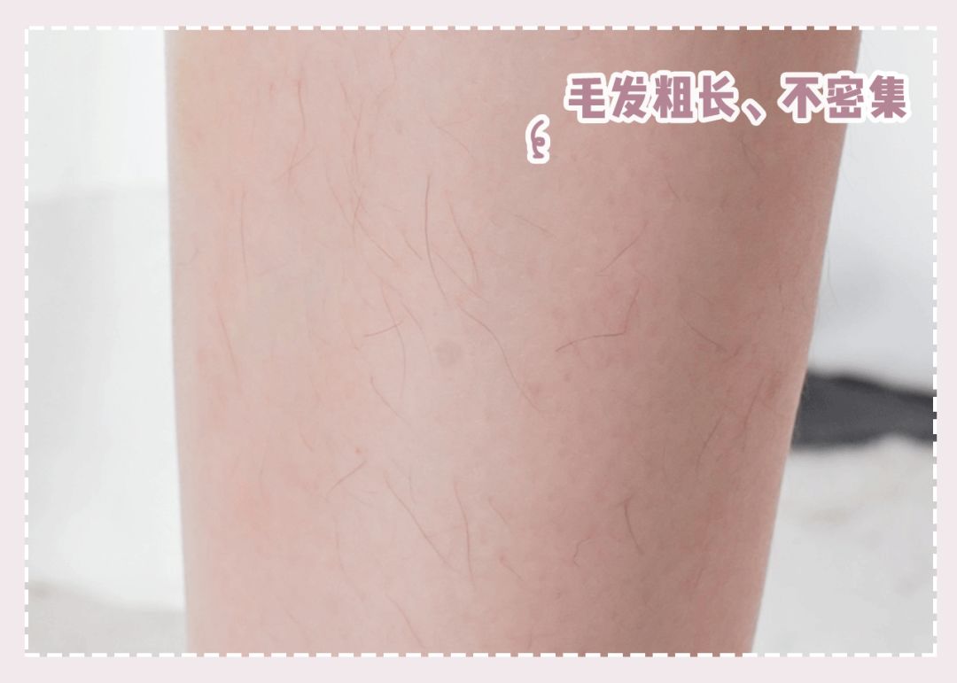 体毛脱毛的效果怎么样,天生体毛旺盛的人正常吗