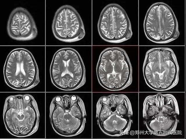 ct胶片的种类,ct胶片有利用价值吗