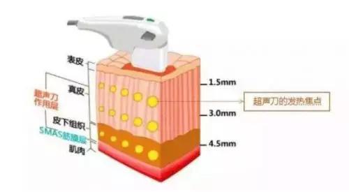 热拉提超声刀热玛吉,超声刀热玛吉真的有用吗