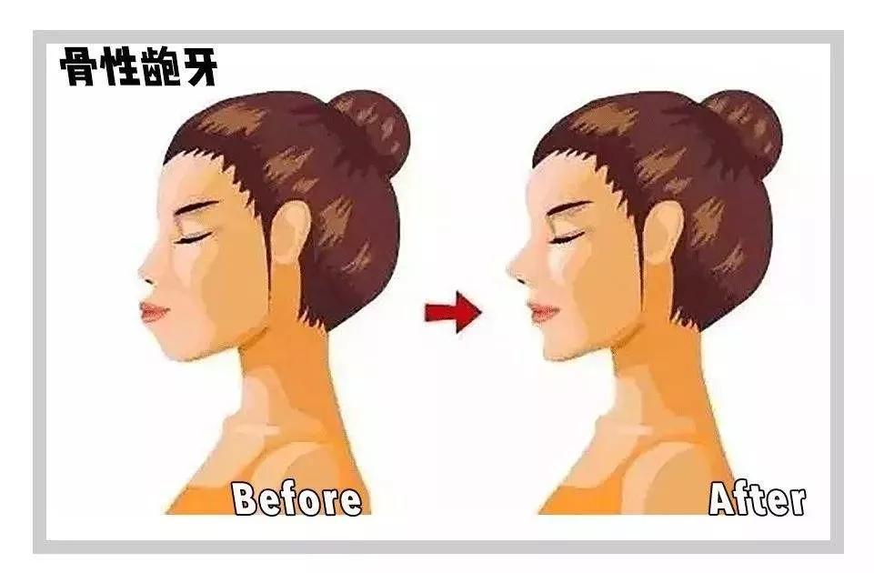 “龅牙”是深覆颌还是深覆盖,两者如何区分?