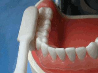 拉锯式刷牙可能造成牙齿缺损,暴力刷牙造成牙齿楔状缺损