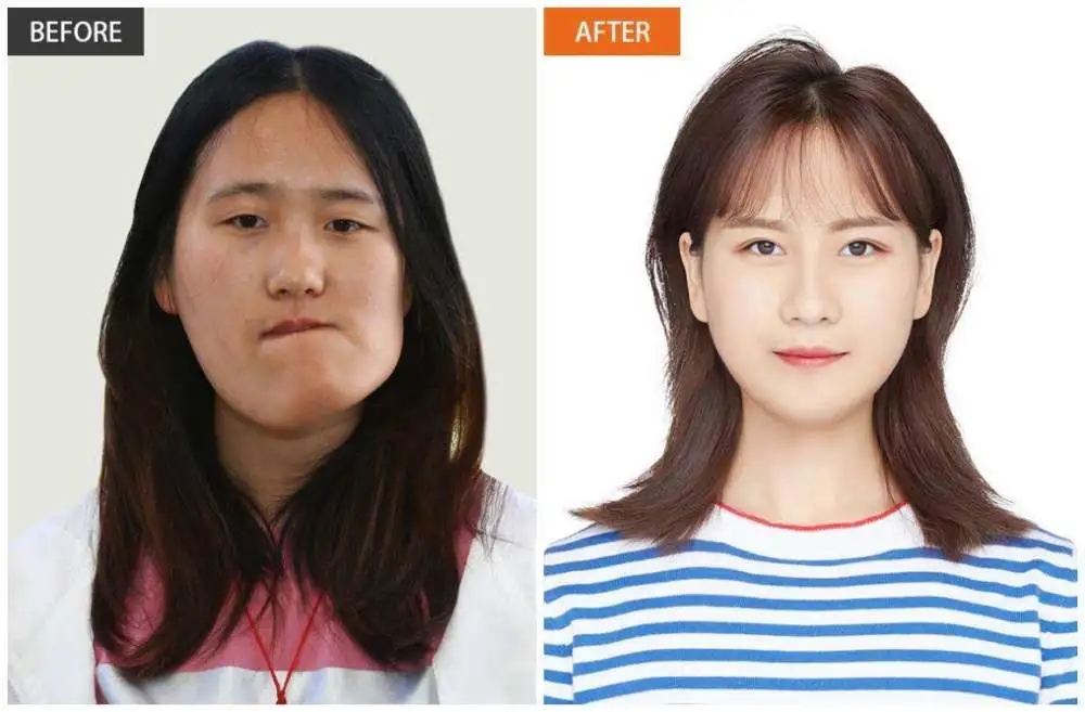 面部畸形整形的女孩,先天面部畸形整形