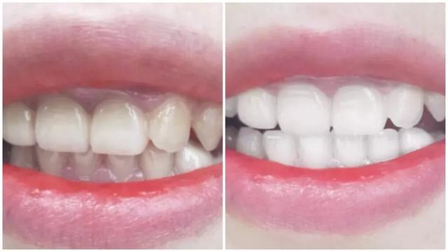 刷牙怎么刷能立刻从黄牙变成白牙,刷牙白牙小妙招