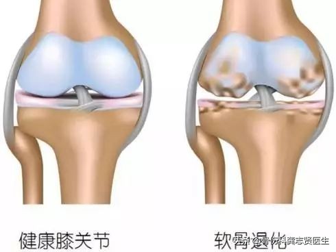 我不是“药神”,治疗膝骨关节炎,不用药