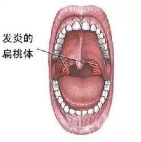 颌下淋巴结肿大预示什么,肺结核为什么引起淋巴结肿大