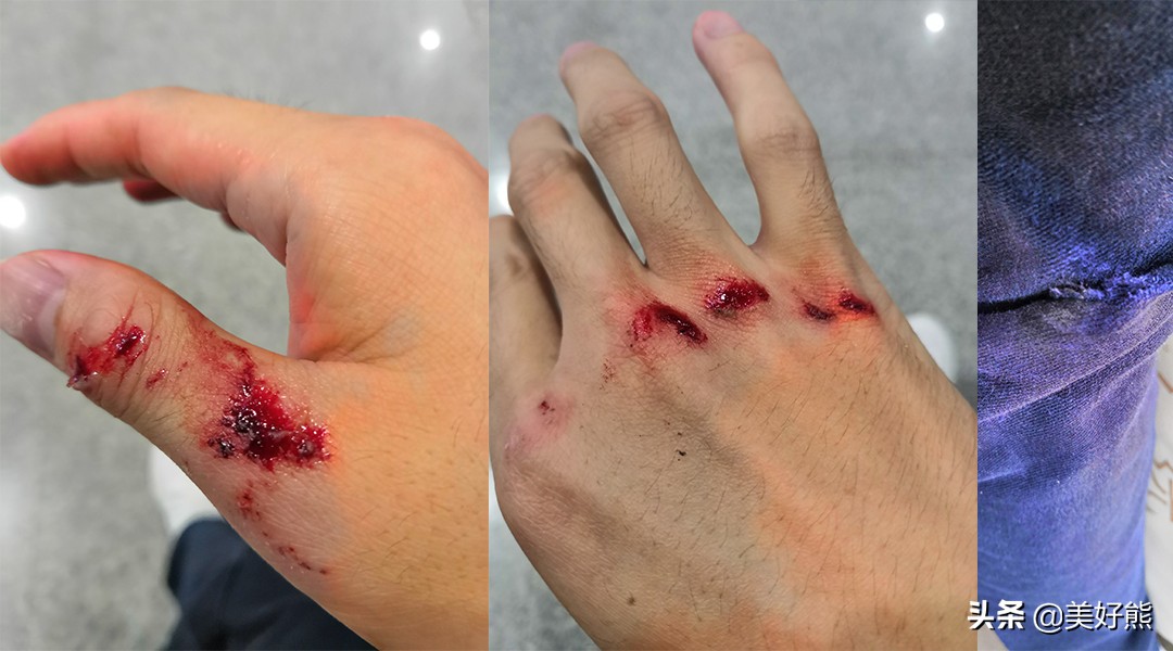 软组织损伤可以用艾灸吗,软组织挫伤艾灸有效吗