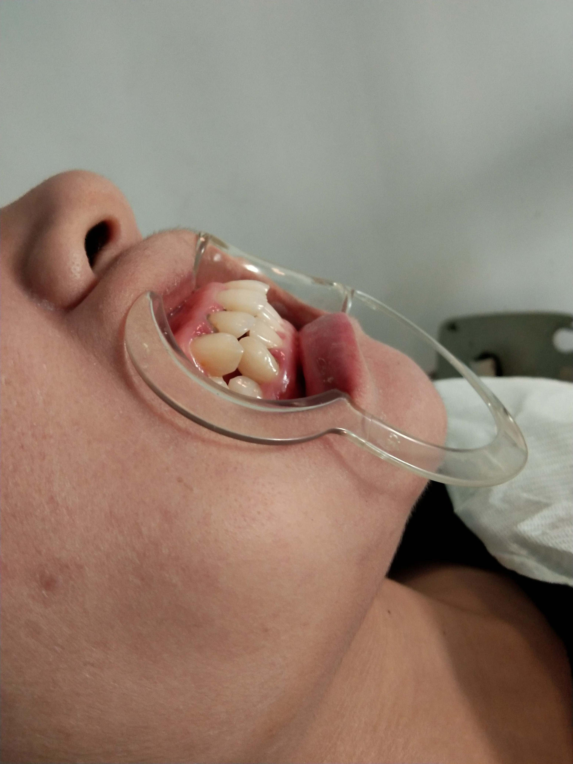 突嘴正颌手术有哪些风险,正颌手术凸嘴3d动画演示