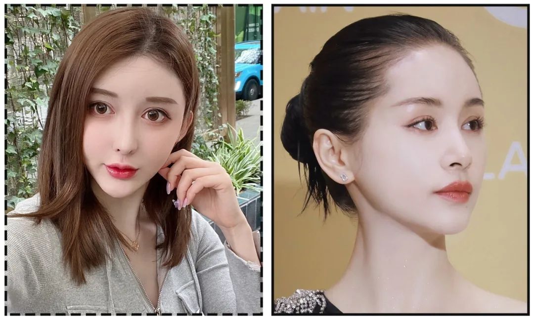 娄艺潇填充脂肪前后对比,娄艺潇填充前后对比