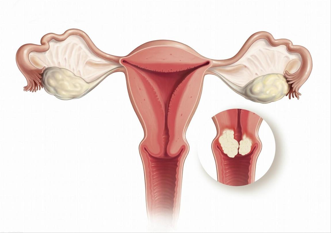 宫颈疾病：孕育门上的一道坎