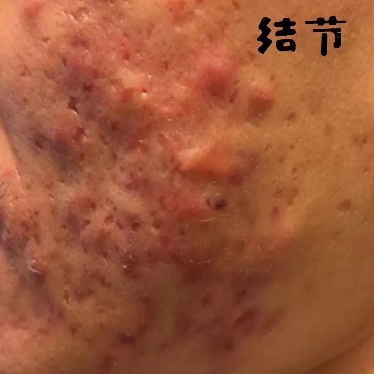 为什么你的痘印总是消不下去,为什么你的祛斑效果不理想