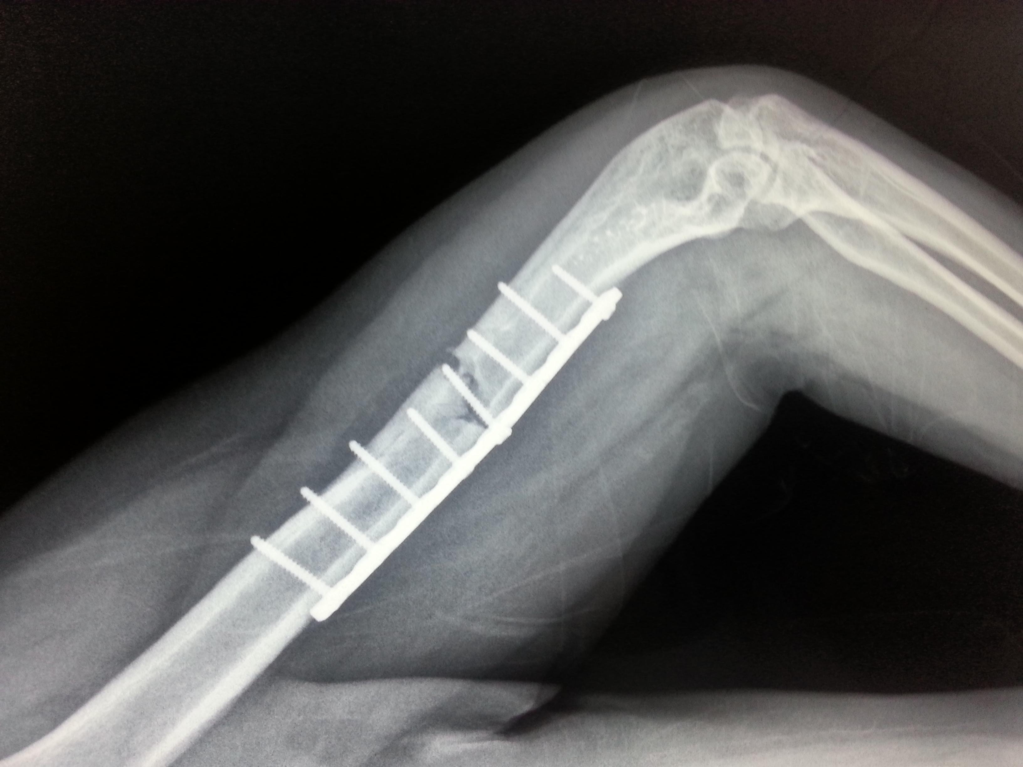 怎么样才能看出骨折完全恢复了,不知道骨折怎么康复锻炼