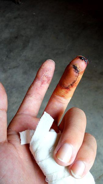 假期里提醒幼儿注意安全,孩子指甲被压伤