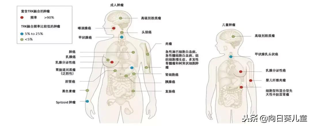 抗癌新特药拉罗替尼的功效,拉罗替尼抗癌成功案例