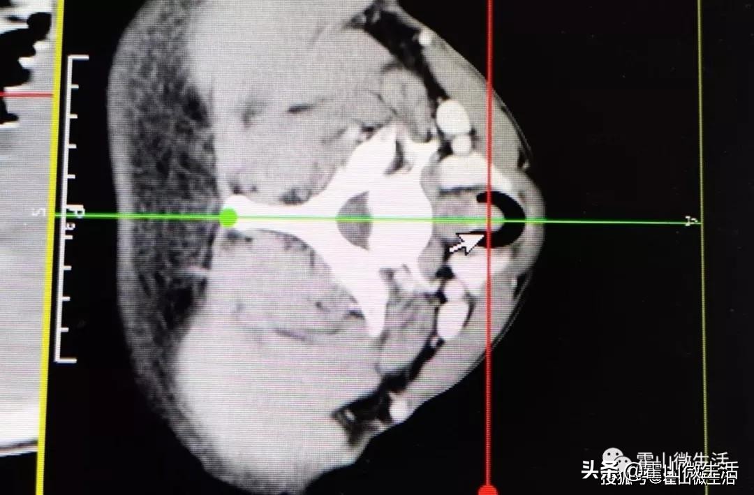 关注！霍山县医院胸外科成功开展气管肿瘤切除、气管重建术