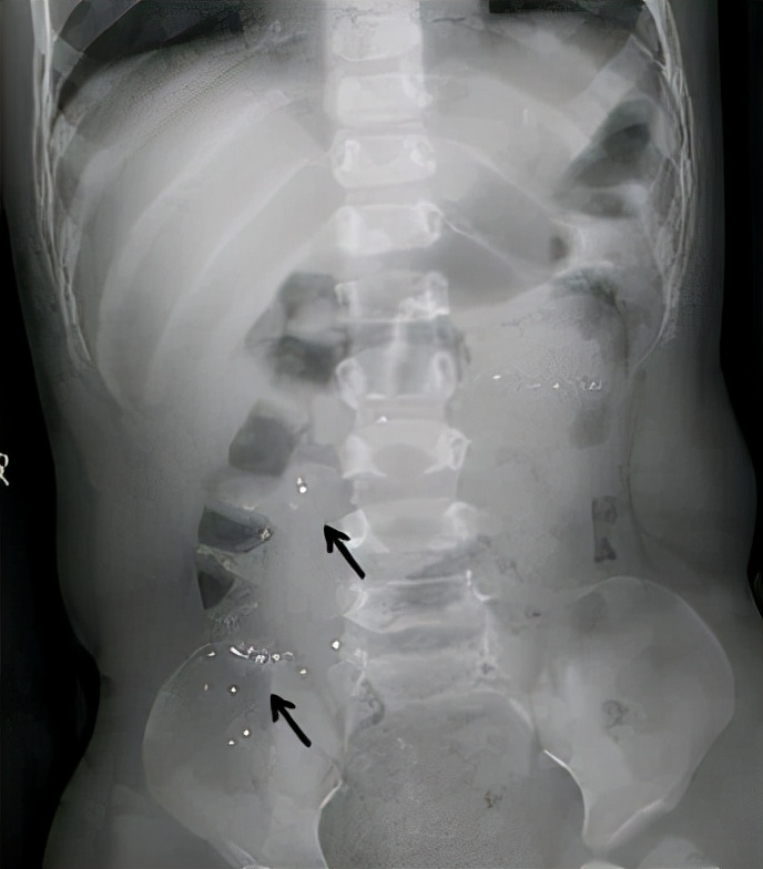 小孩子咬破水银体温计怎么办,孩子咬破体温表吃了水银会怎么样