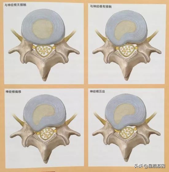 鑵版闂寸洏绐佸嚭鑳芥牴娌讳箞,鑵版闂寸洏绐佸嚭鍘嬭揩绁炵粡