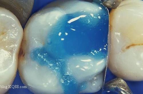 补牙“油水”有多大？补牙前，请一字不漏地看完