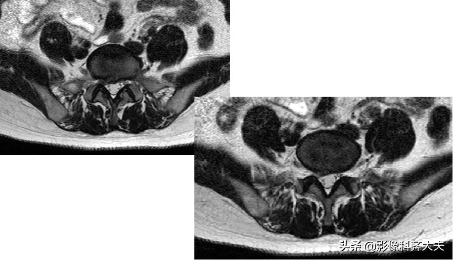 腰椎间盘突出的影像学诊断及治疗,腰椎间盘突出影像学课件