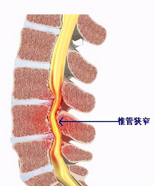 腰椎管狭窄微创手术有几种,腰椎狭窄微创手术有什么害处