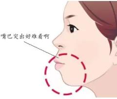 龅牙和嘴突的区别,龅牙嘴突适合什么发型