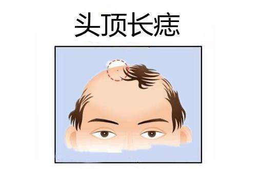 点痣有讲究吗哪里的痣不能点,点痣真的影响自身风水吗