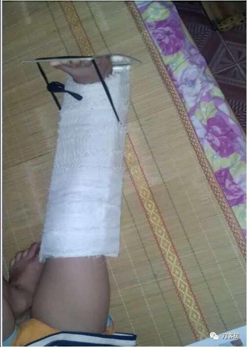 一个脊柱外科医生与马蹄内翻足的纠缠-写在6.3国际马蹄内翻足日前